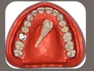 TM-DK Replacement Tooth Model